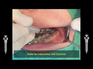 Tusk Denta Mini Screw - Buccal Shelf Placement (Mandible) Orthodontics