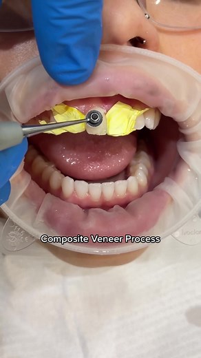Dr Richard using direct composite veneers to correct the shape & position of the teeth. The composite veneers also allowed for the gaps to be closed. Composite veneers are a process where the composite resin is placed over the full front surface of the tooth. In this way we can change the colour of the tooth also ☁️🤍