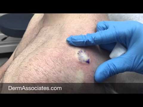 Electrodessication and Curettage of a BCC