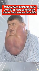 This man had a giant lump on his neck for 16 years,and the doctor's found next was incredible... #truestory #fypviralシ #truth #realstory #foryou #fypシ゚viralシfypシ゚viralシalシ | Did you know ?