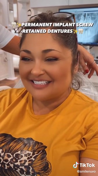 ✨🦷THESE ARE JUST TEMPORARIES🦷✨Implants can anchor a removable full denture to keep it from slipping or, better yet, an entire arch of upper or lower replacement teeth that are fixed into the mouth and are never removed. These teeth can take the form of fixed bridgework, which is a full set of replacement dental crowns; or a fixed denture, which contains crowns as well as realistic-looking prosthetic (replacement) gum tissue. Sometimes a new arch of teeth can be supported by as few as 4 implant