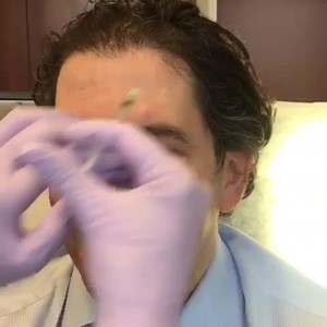 Botox for Men - Addressing Forehead Lines and Glabella Lines