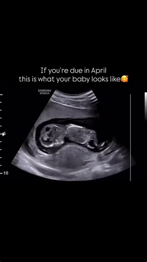 2D/3D-4D/5D HD Ultrasound on Instagram: "Where all the April mamas at? Did you know at 14 weeks, we can see your baby’s gender? We can also see flips, kicks, spins, jumps, hiccups, yawns, punches and even baby drinking amniotic fluid. Perfect time to see baby’s whole body on the screen. Make an appointment today or Send to your pregnant bestie. Let’s make Memories✨🤍"