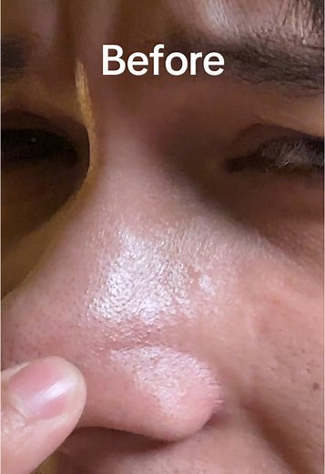 Ultimate Guide to Unclogging Pores: Before and After Results!