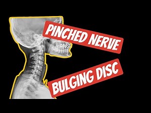 3 Exercises For A Bulging Disc In The Neck