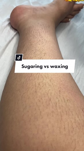 Sugaring vs Waxing: Which is Better for Hair Removal?