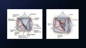 #271: Torcular Craniotomy and Occipital-Transtentorial Approach for Resection of a Low Quadrigeminal Midbrain Cavernous Malformation - All Videos - Seven Series Collection