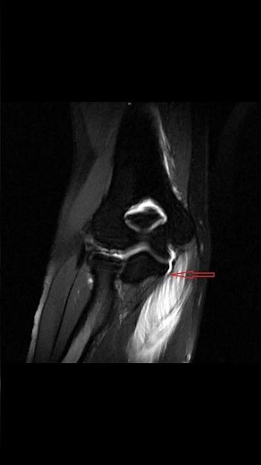 UCL Tears Explained: Symptoms, Diagnosis & Treatment #elbowpain #meded #physiotherapy #ATC