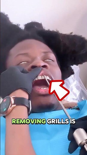 You Won’t Believe How They Remove Permanent Grills!
