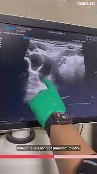 Lymphangioma on neck ultrasound-a cystic swelling.