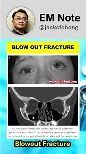 Orbital Blowout Fractures
