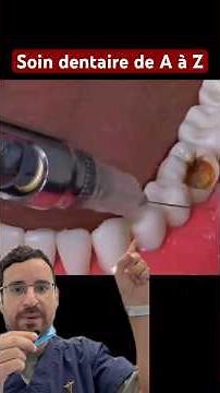 Restauration carieuse avec dévitalisation et onlay : une approche moderne et conservatrice