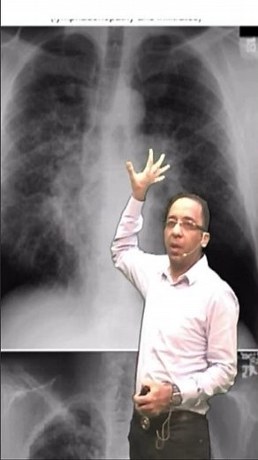 Let’s learn about stages of sarcoidosis today #radiology #neetpg #fmge #inicet