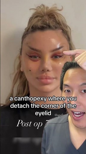 Cat Eye Surgery? Worth It?