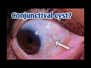 Conjunctival cyst ? condition explained indetail ‪@eyecareoptom5506‬ #cyst #conjunctiva #eye #oil