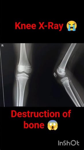 "Knee Joint X-Ray | Positioning & Anatomy | Radiography Tutorial"#short