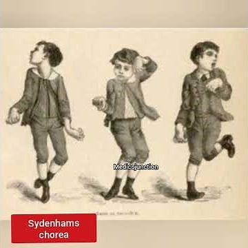 Sydenham's chorea