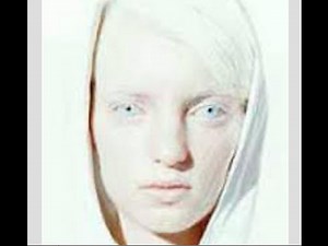 【震撼】人種差別！高額取引！アルビノ患者狩りの真実！