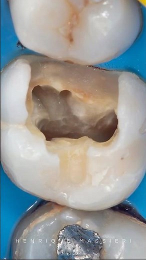 Class 2 restoration using Garrison’s Deep Margin Elevation Kit