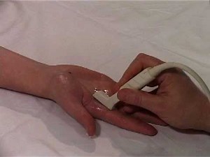 Musculoskeletal Ultrasound: Hand 5: palmar longitudinal scan of MCP joint