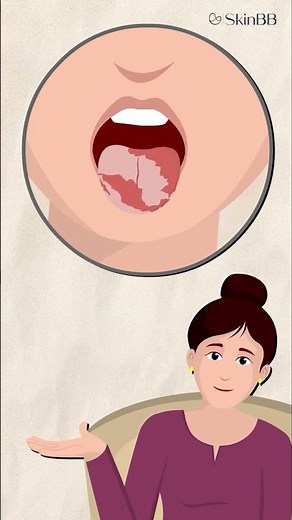 White Marks On Tongue? Oral Thrush Or Cancer?