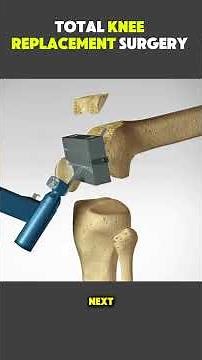 How Total Knee Replacement Surgery Is Performed | Step-by-Step Explained #kneereplacementsurgery