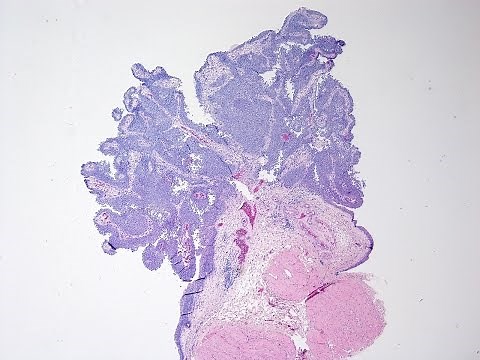 Bladder Cancer - Pathology mini tutorial