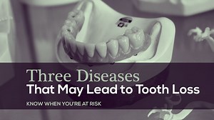 3 Diseases that May Lead to Tooth Loss — The McKenzie Center | Implants & Periodontics