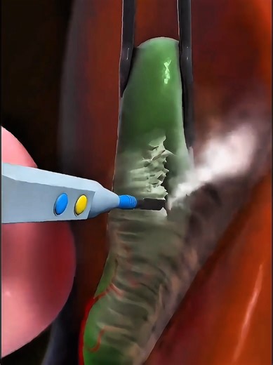 Understanding Laparoscopic Gallbladder Removal