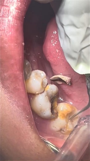 cleaning tartar and calculus from posterior teeth #dentist #smiledesigndental #dentalfilling #teeth