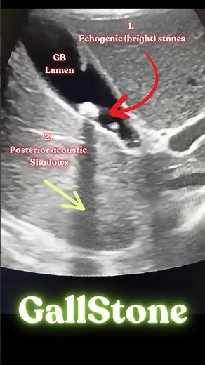 Gallstones Diagnosis on Ultrasound Abdomen #cholelithiasis #gallstones