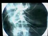 Coronary Angiography • Video • MEDtube.net