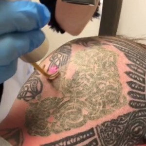 2.3K views · 14 reactions | Heads ! Tattoo removal isn't just for arms and legs. Our techs and PicoWay laser technology can remove any ink -- no matter the color, density or location!  bit.ly/InvisInk | Removery | Facebook