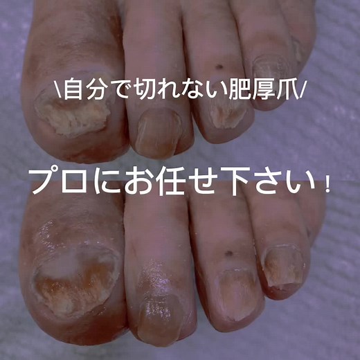 爪白癬と肥厚爪の専門ケア