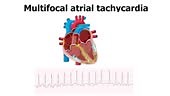 real ecg that demonstrate multifocal atrial tachycardia along with...