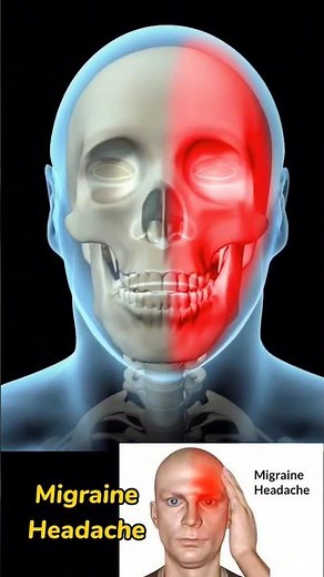 Migraine headache 3D animation #medical