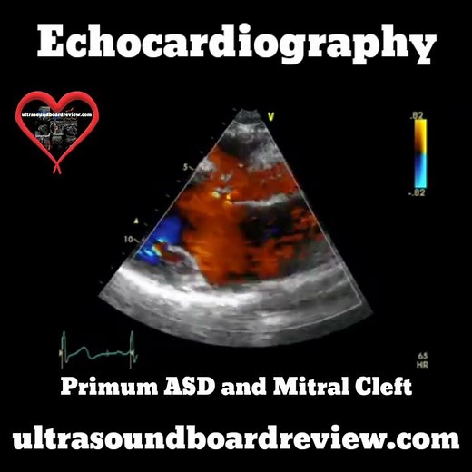 Cleft Mitral Valve