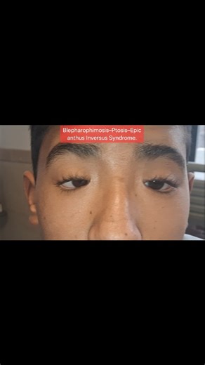 DR JAHANZAIB RAO on Instagram: "BPES – only in 5 lines..🙂 BPES is a congenital, autosomal dominant eyelid syndrome due to FOXL2 mutation. Characterized by blepharophimosis, severe bilateral ptosis, epicanthus inversus, and telecanthus. Ptosis is usually associated with poor levator function. Stage 1 surgery: correction of telecanthus and epicanthus (medial canthoplasty). Stage 2 surgery: ptosis correction, usually by frontalis sling."