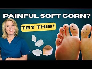 How to Treat Soft Corns at Home – Podiatrist-Recommended Tips