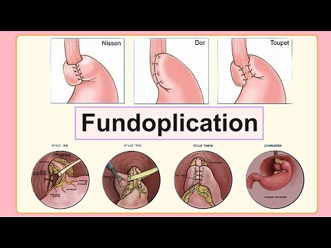 fundoplication