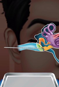 4 comments | #myringotomy A myringotomy is a surgical procedure in...