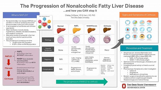 The Progression of Nonalcoholic Fatty Liver Disease…and How You CAN Stop It - American Liver Foundation