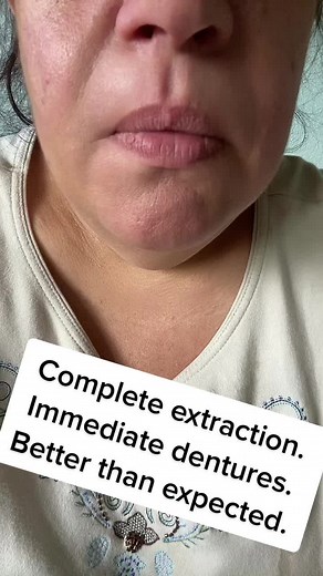 Initial Experience with Immediate Dentures and Extractions