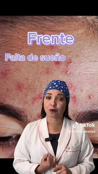 Qué significa tu acné: Consejos de belleza y spa en Quito