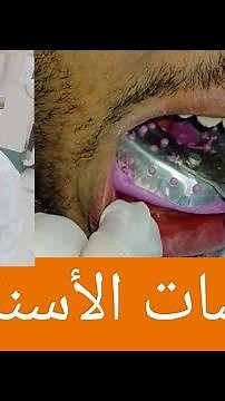 كيفية عمل مقاسات الأسنان || طبعة الاسنان لعمل تركيبة ثابته