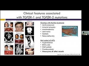 A Cardiologist's Guide to Loeys Dietz Syndrome