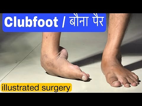 Club foot corrective surgery in adult,Corrective osteotomy with tendon release operation.