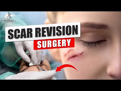 Scar Revision Surgery Before and After | Scar Revision Surgery Hospital India | Scar Removal Therapy