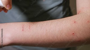 Woman handles scratches and bites on her arm. Stock Video