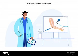 Illustration of elbow arthroscopy surgery. This is a procedure for diagnosing and treating joint problems. A surgeon inserts a narrow tube attached to a fibre-optic video camera through a small incision Stock Photo - Alamy
